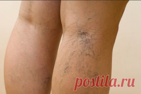 Варикоз и хроническая венозная недостаточность - далеко не одно и то же. Варикоз относят к внешним проявлениям венозного заболевания, он подразумевает расширение вен и высыпание подкожных «звездочек». Под венозной недостаточностью имеется в виду нарушение работы венозных клапанов. В то же время варикозное расширение вен может быть одним из проявлений хронической венозной недостаточности.
Все венозные проблемы имеют наследственную природу и больше передаются по женской линии