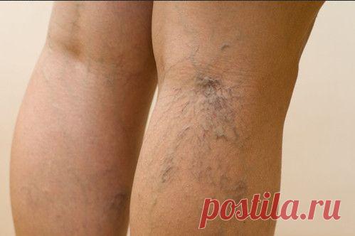 Варикоз и хроническая венозная недостаточность - далеко не одно и то же. Варикоз относят к внешним проявлениям венозного заболевания, он подразумевает расширение вен и высыпание подкожных «звездочек». Под венозной недостаточностью имеется в виду нарушение работы венозных клапанов. В то же время варикозное расширение вен может быть одним из проявлений хронической венозной недостаточности.
Все венозные проблемы имеют наследственную природу и больше передаются по женской линии