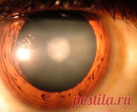 Найден способ вылечить катаракту с помощью глазных капель