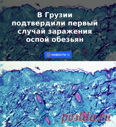 15-6-22-В Грузии подтвердили первый случай заражения оспой обезьян - Новости Mail.ru