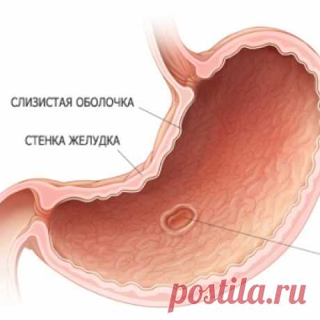 10 симптомов язвенной болезни, которые нельзя игнорировать