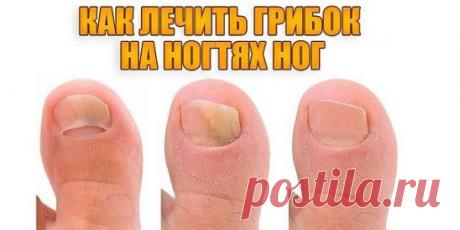 Как лечить грибок на ногтях ног
1 ложку нашатырного спирта необходимо развести в стакане воды. В этом растворе необходимо смочить любую ткань, но только не синтетическую. Этой тряпкой необходимо обернуть пораженный палец, наверх надеть целлофановый пакет, а затем носок. Эти действия необходимо повторить в течение 5 дней, после чего грибок исчезнет.
Необходимо приготовить мазь из сырого куриного яйца, 1 столовой ложки уксуса, 1 столовой ложки растительного масла и 1 чайной ложки диметилфталата. В