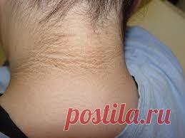 Когда темные кольца появились вокруг шеи ребенка - доктор определил эту серьезную болезнь Вы должны это знать! Когда четырнадцатилетняя Пантера заболела и внезапно появилось темное кольцо вокруг ее шеи, ее мать обеспокоилась, поскольку она