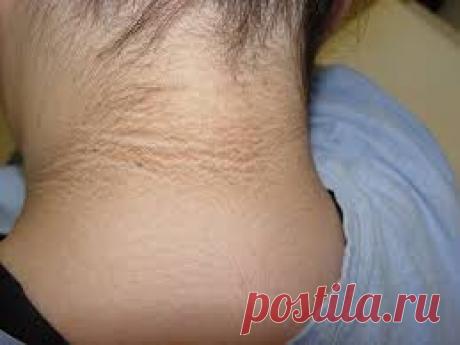 Когда темные кольца появились вокруг шеи ребенка - доктор определил эту серьезную болезнь Вы должны это знать! Когда четырнадцатилетняя Пантера заболела и внезапно появилось темное кольцо вокруг ее шеи, ее мать обеспокоилась, поскольку она