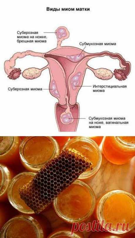 Лечение миомы матки народными средствами в домашних условиях