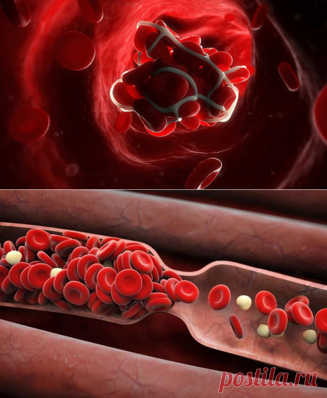 Это необходимо знать — профилактика образования тромбов