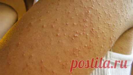 Полезные советы: Она понятия не имела, откуда взялась странная сыпь на руках… Тревожные сигналы серьезной болезни.