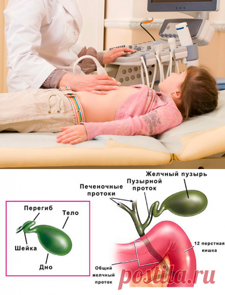 Перегиб желчного пузыря