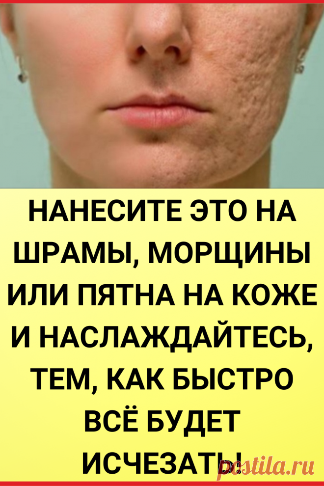 Нанесите это на шрамы, морщины или пятна на коже и наслаждайтесь, тем как быстро все будет исчезать!