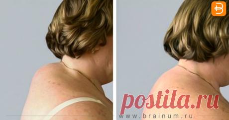 Легко избавляемся от холки на спине
Вдовий горбик, загривок, холка, жировик – вот народные названия этой проблемы. Чаще всего данная неприятность настигает женщин, начиная от 40 лет. Почему появляется холка на шее, как избавиться от нее? У многих женщин после 35-40 лет в области седьмого шейного позвонка часто появляется «холка» — жировые отложения у основания шеи. «Холка» способна сдавливать артерии, что […]
Читай дальше на сайте. Жми подробнее ➡