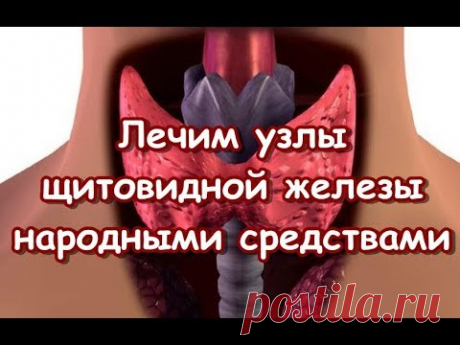 Лечим узлы щитовидной железы - народными средствами