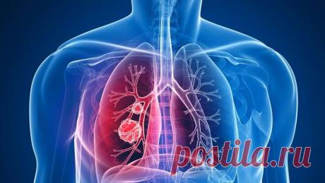 Кому следует опасаться РАКА ЛЁГКИХ | Андрей КТ МРТ | Дзен
