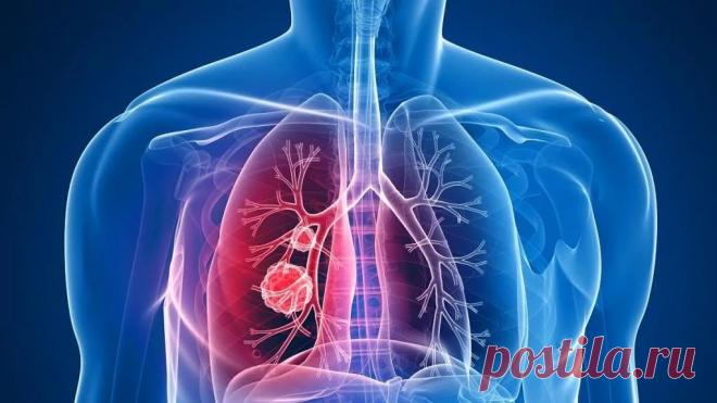 Кому следует опасаться РАКА ЛЁГКИХ | Андрей КТ МРТ | Дзен