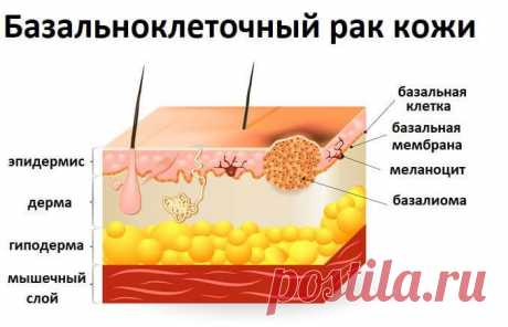 Лечение базалиомы или базальноклеточного рака в Уфе