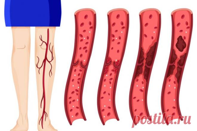 9 опасных симптомов тромбоза, которые ни в коем случае нельзя игнорировать Тромбы – это сгустки крови, которые формируются в просвете кровеносных сосудов в ответ на повреждение сосудистой стенки. Именно тромбы принимают участие в процессе гемостаза (предупреждают возникновение сильного кровотечения, если вы, например, порезались). Более того, у большинства людей в организме ежедневно образуются сгустки крови, однако они зачастую моментально рассасываются и не вызывают ника...