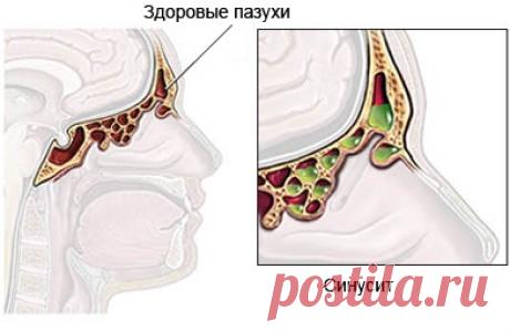 Как облегчить инфекцию пазух носа за 30 секунд! — Полезные советы