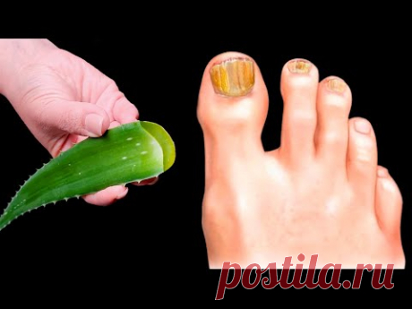 🔥Устраняет грибок ногтей МГНОВЕННО! Лучшее средство! Преимущества алоэ! 🌿😍