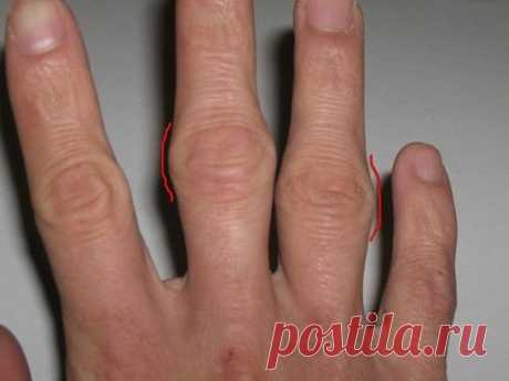 *ПОЛЕЗНЫЕ СОВЕТЫ ИЗ БАБУШКИНОЙ ШКАТУЛКИ*  
Лечим косточки на суставах