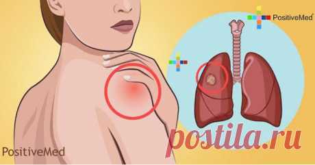 10 предупреждающих симптомов рака легких, которые никогда не должны игнорироваться!