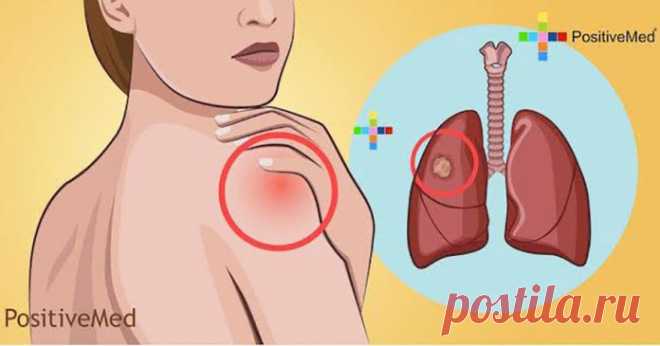 10 предупреждающих симптомов рака легких, которые никогда не должны игнорироваться!