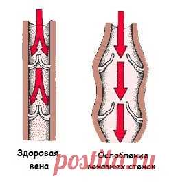Причины варикоза ног и его устранение &#8212; Всегда в форме!