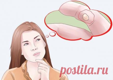 Домашние средства от незначительных ожогов | Полезные советы