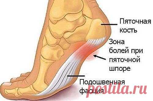 РЕЦЕПТ ЛЕЧЕНИЕ ШИШЕК И ПЯТОЧНОЙ ШПОРЫ 
Посылаю вам рецепт лечения пяточной шпоры и шишек возле большого пальца ноги. Его мне дал молодой врач лет 15 назад. Он сказал: «Больничный лист по этому поводу я выписать не могу, не положено. Но моя бабушка лечилась от этих неприятностей так:...» Я взяла на вооружение совет его бабушки, вылечилась сама и много женщин на работе вылечила. 
Рецепт очень простой и недорогой. З—4 горсти морской соли (можно и поваренной если капнуть в нее несколько капель йода)