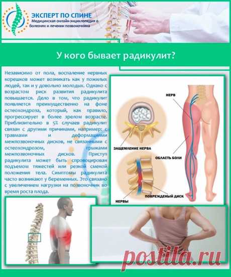 У кого бывает радикулит?
