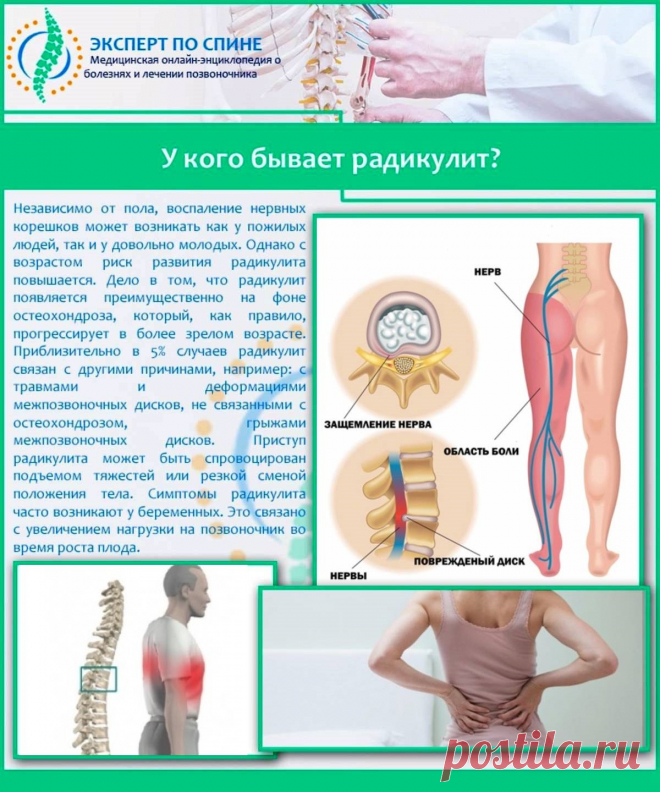 У кого бывает радикулит?
