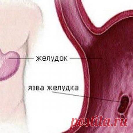 Диета при язве желудка — общие сведения и результат