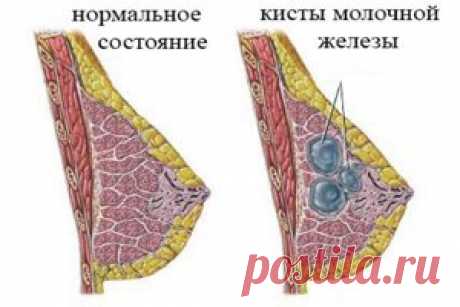 Киста молочной железы – причины, симптомы, виды и лечение кисты молочной железы