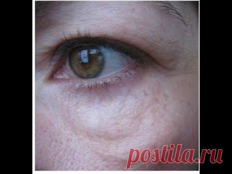 #малярные_мешки #скуловая_грыжа МАЛЯРНЫЕ МЕШКИ: как убрать дом?