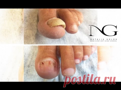 Онихомикоз: обработка ногтя. Эфир Periscope / Onychomycosis. Nail treatment