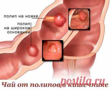 Чай от полипов в кишечнике! — Домашние