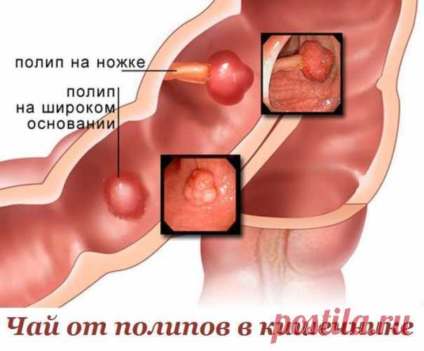 Чай от полипов в кишечнике! — Домашние