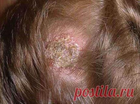 Стригущий лишай или трихофития - симптомы, заражение, диагностика, лечение и профилактика.