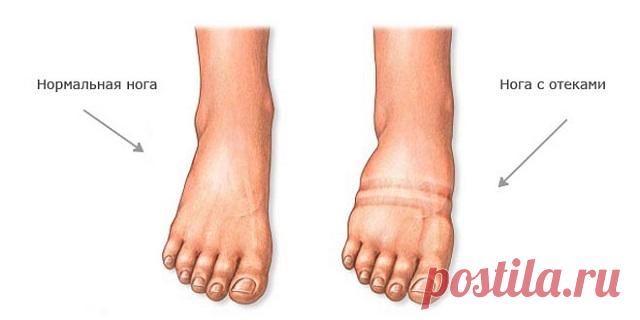 ОТЕКИ НОГ: ЧТО ДЕЛАТЬ? 
Лечение отека ног проводится только после врачебного обследования, т.к. причин может быть несколько, и прежде всего необходимо поставить правильный диагноз, чтобы назначить правильное лечение.
Распро…