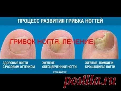 ГРИБОК НОГТЯ. КАК БЫСТРО  ВЫЛЕЧИТЬ   ГРИБОК НОГТЯ ?  СРЕДСТВО РАБОТАЕТ НА 100%.