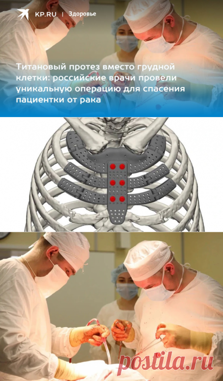 ТИТАНОВЫЙ ПРОТЕЗ вместо грудной клетки: российские врачи провели уникальную операцию для спасения пациентки ОТ РАКА - KP.RU