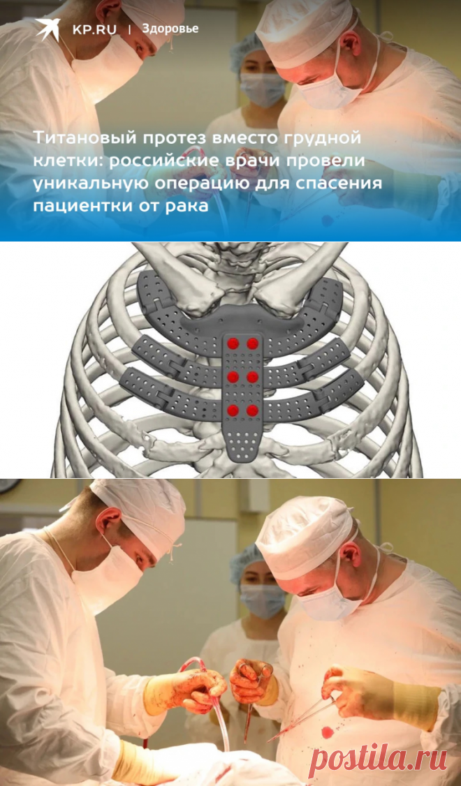 ТИТАНОВЫЙ ПРОТЕЗ вместо грудной клетки: российские врачи провели уникальную операцию для спасения пациентки ОТ РАКА - KP.RU