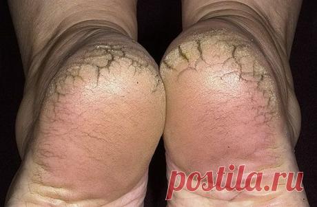 Трещины на пятках-что делать...