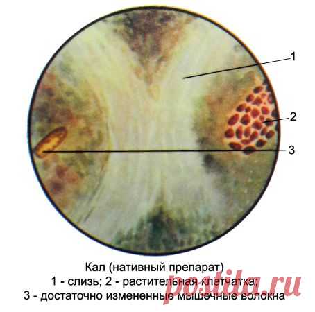 Клинический анализ кала (копрограмма)