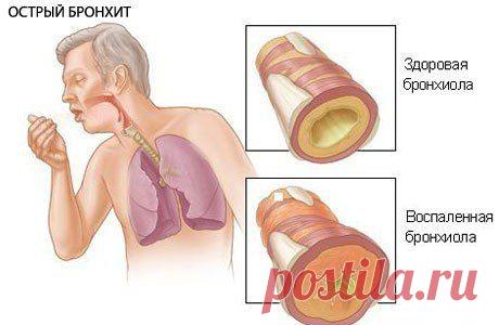 Лечение бронхита народными средствами