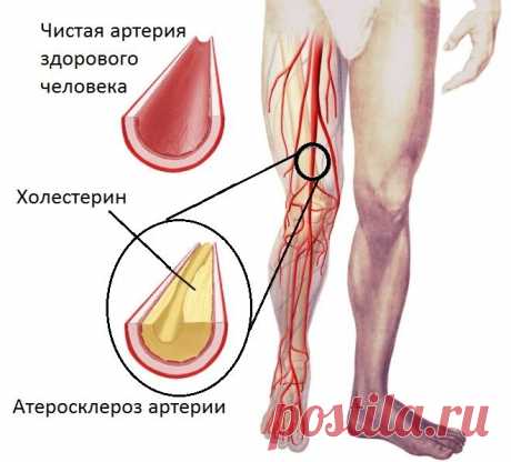 Лечение атеросклероза народными средствами / Будьте здоровы