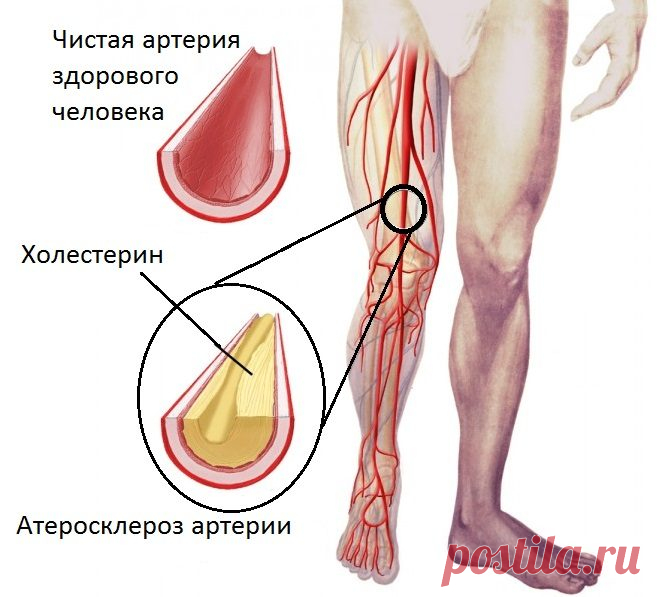 Лечение атеросклероза народными средствами / Будьте здоровы