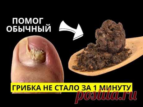 ВЫЛЕЧИЛ Грибок Ногтей спустя 30 лет за 1 МИНУТУ! Лечение грибка ногтей на ногах легко!