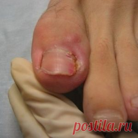 ЛЕЧЕНИЕ ВРОСШЕГО НОГТЯ