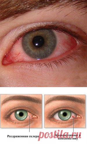 Красные глаза: причины и лечение