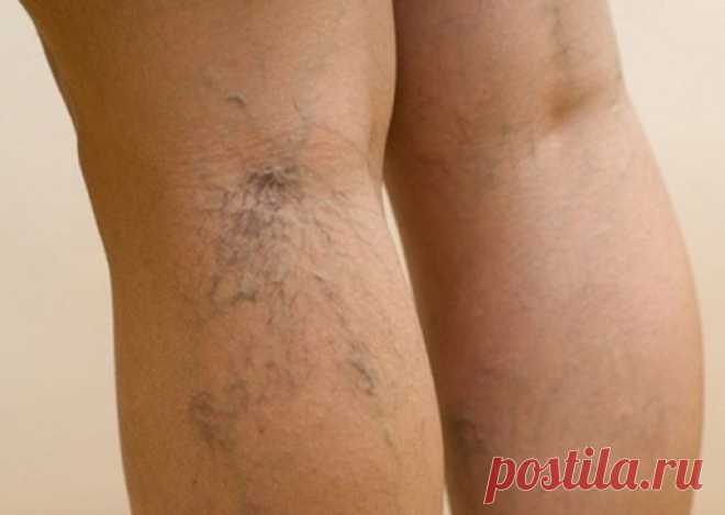 Не давай лифме застаиваться! Если ноги отекают, важно не допустить губительной ошибки… - pro100soveti.ru