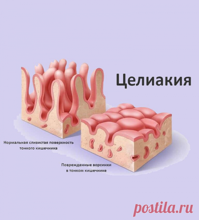 Целиакия не только может вызывать тревожные симптомы, которые могут ухудшить качество жизни, но также несет в себе риск некоторых потенциально серьезных осложнений, если её не лечить.